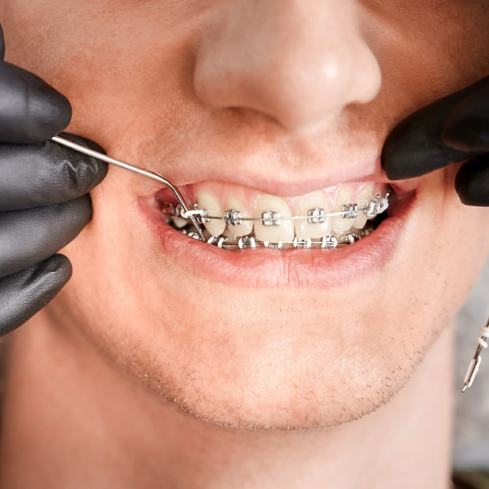 Orthodontic Treatment
