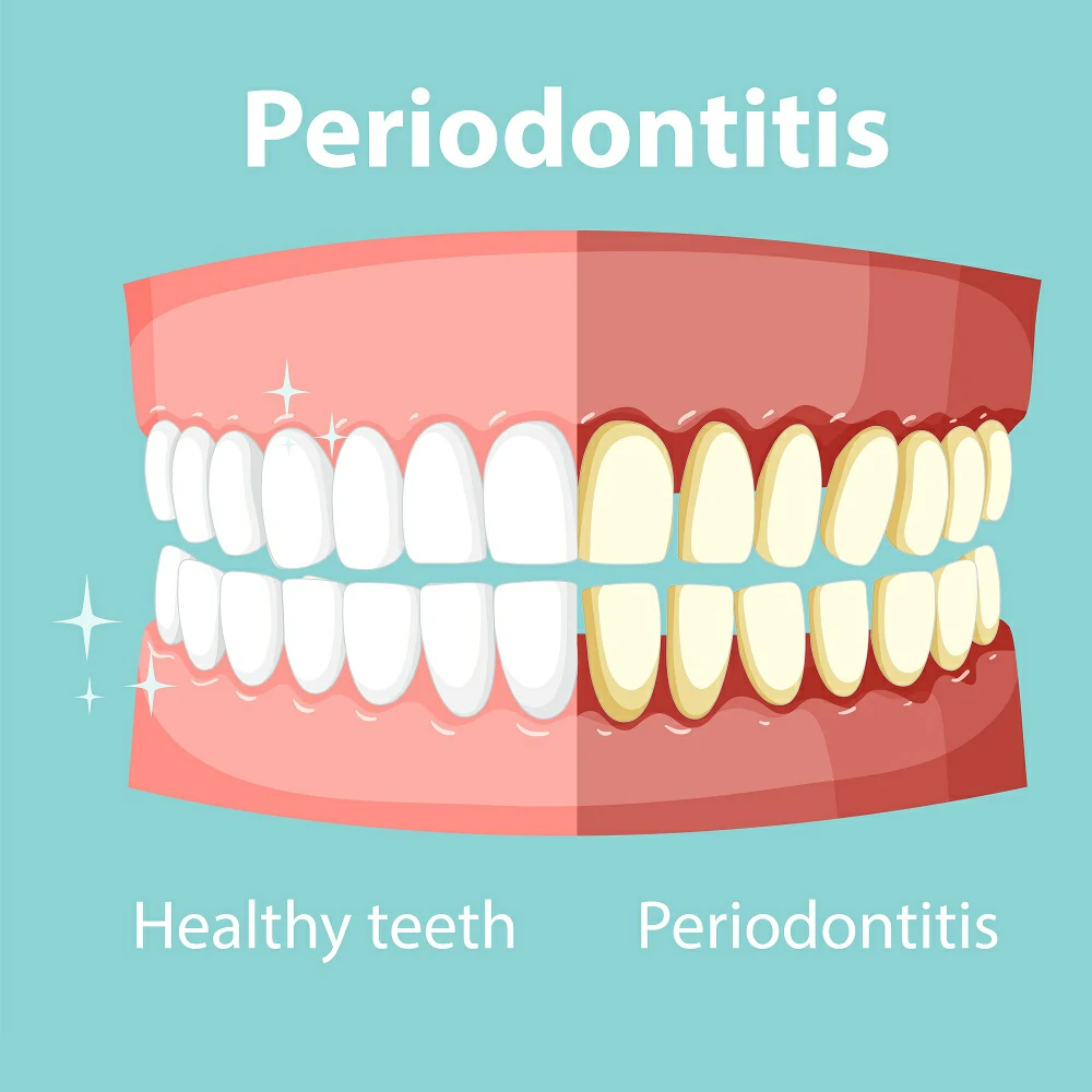 Periodontal Treatment